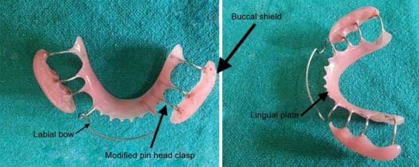 Dentist made cheek plumper to prevent cheek biting 