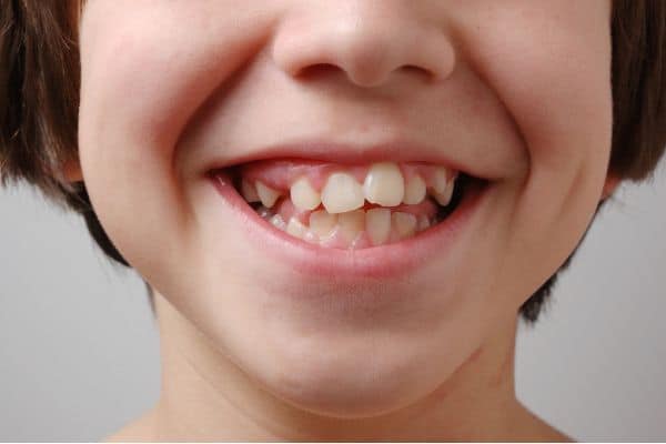 Child with uneven teeth